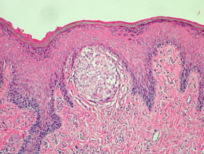 Metastatic Crohn disease pathology