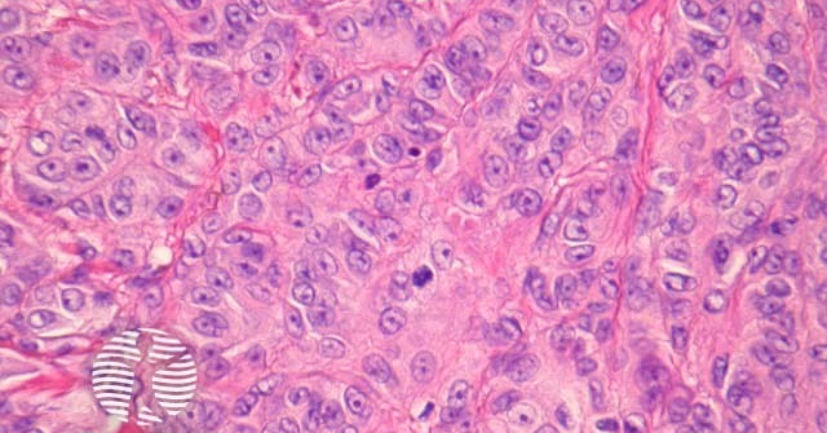 Metastatic melanoma pathology image