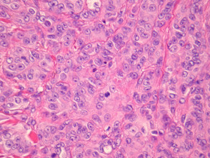 Metastatic melanoma pathology