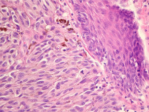 malignant melanoma histology