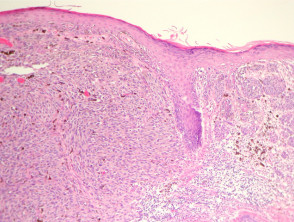 malignant melanoma histology