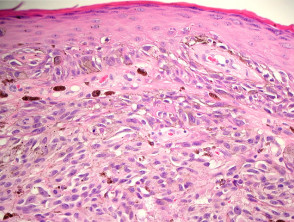 acral lentiginous melanoma histology