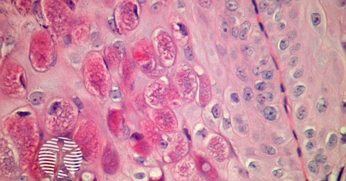 Molluscum contagiosum pathology image