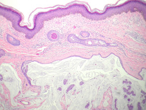 Mucinous carcinoma pathology