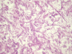 aspergillosis histology
