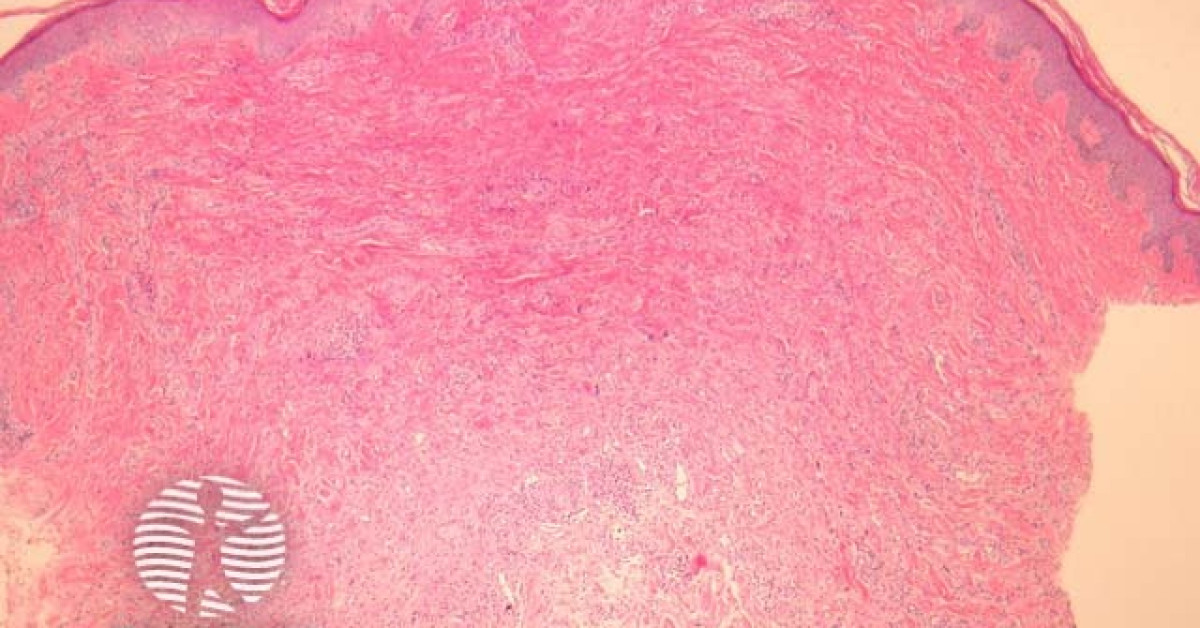 Multinucleate cell angiohistiocytoma pathology image