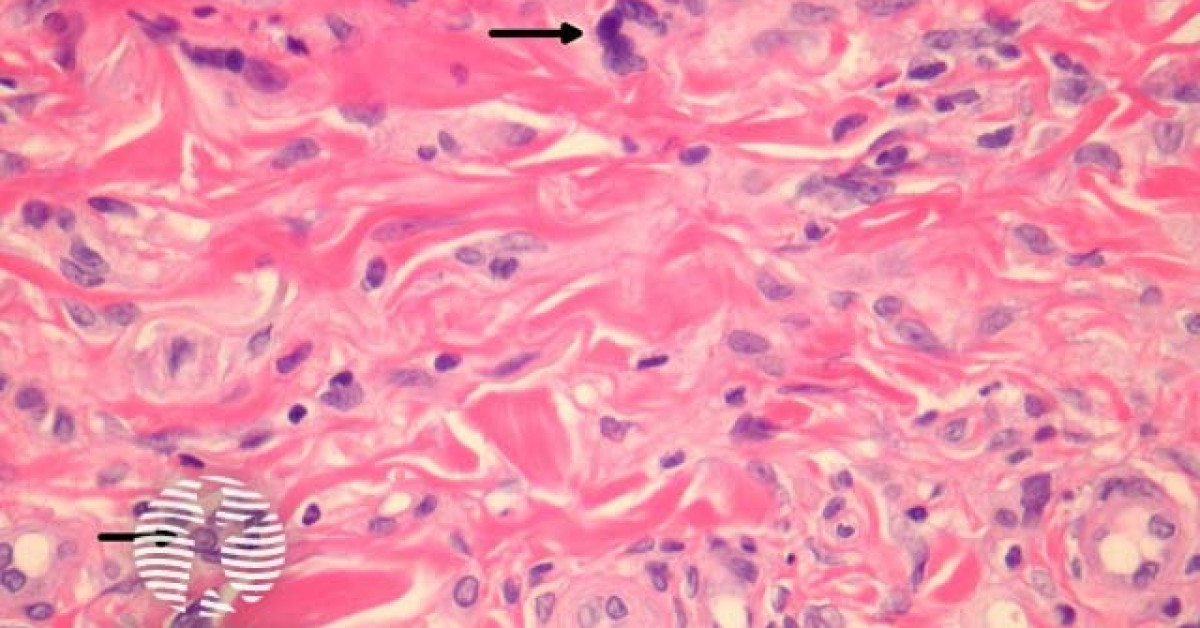 Multinucleate cell angiohistiocytoma pathology image