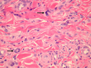 Multinucleate cell angiohistiocytoma pathology