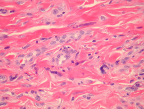 Multinucleate cell angiohistiocytoma pathology