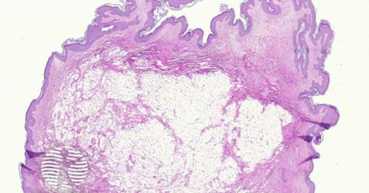 Naevus lipomatosus superficialis pathology image