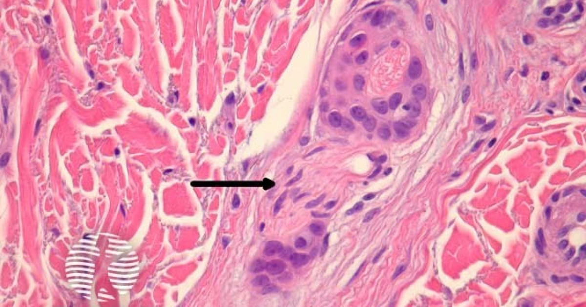 Squamous cell carcinoma pathology image