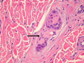 Squamous cell carcinoma pathology