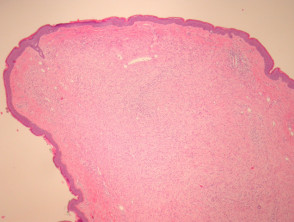Neurofibroma pathology