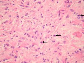 Neurofibroma pathology