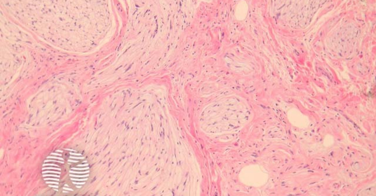 DermNet® - Neurothekeoma pathology image