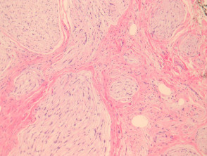 Neurothekeoma  pathology