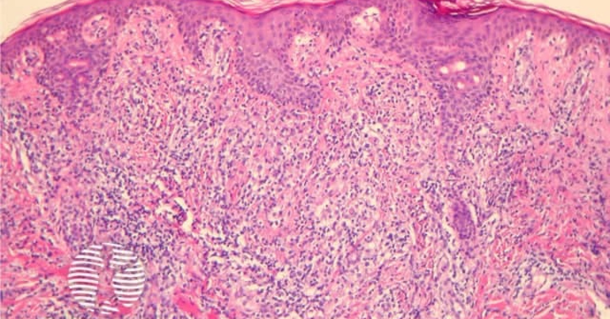 Extranodal NK/T cell lymphoma, nasal type pathology image