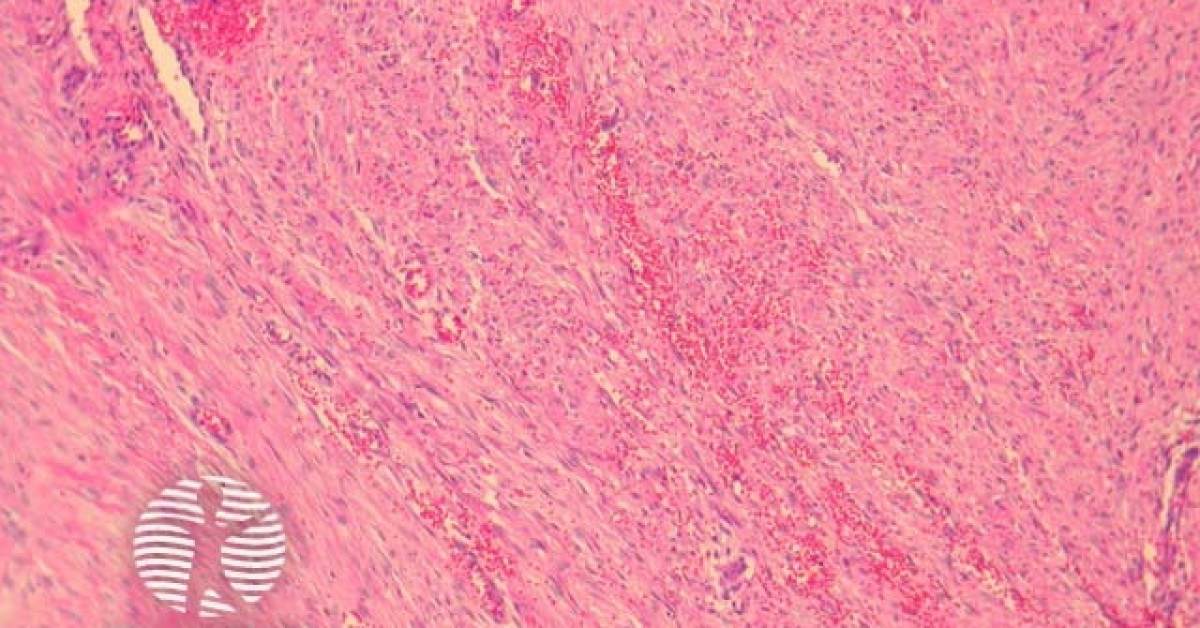 DermNet® - Nodular fasciitis pathology image