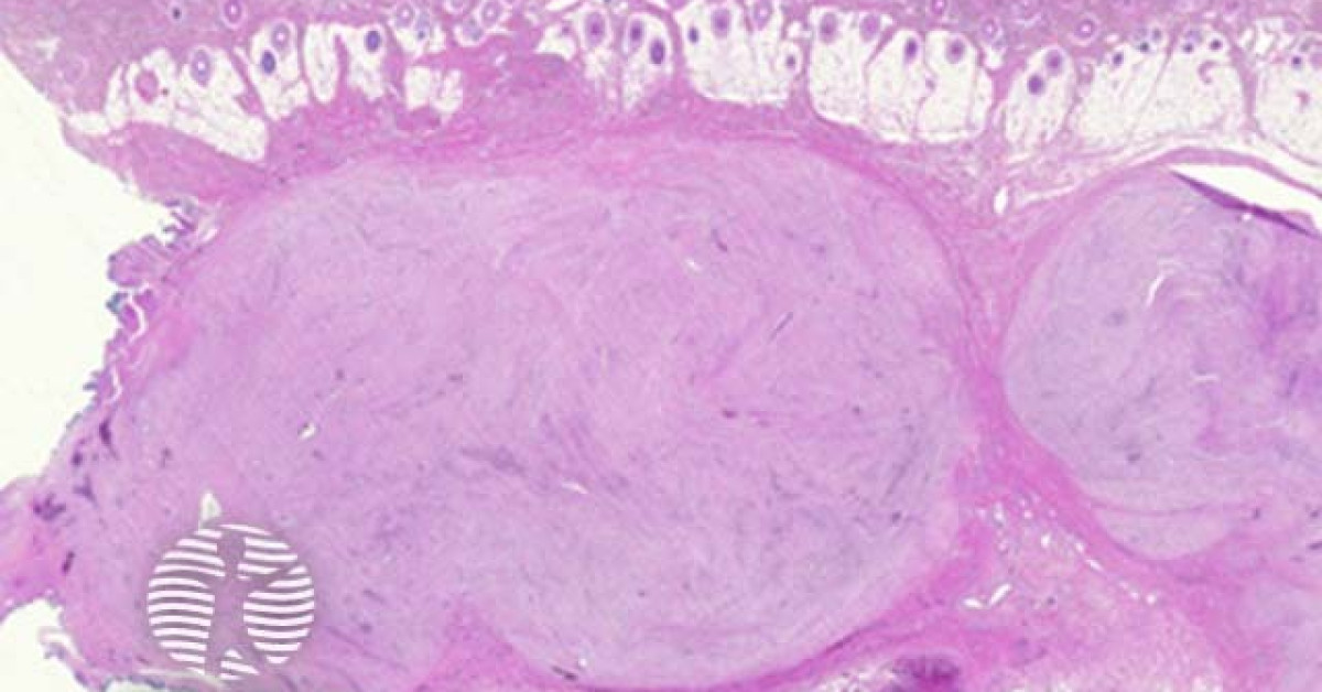 DermNet® - Nodular fasciitis pathology image