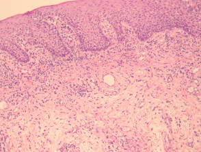 Orofacial granulomatosis pathology