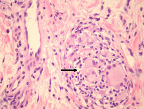 Orofacial granulomatosis pathology | DermNet NZ