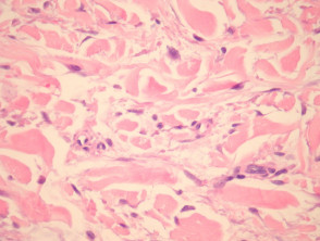 Papular mucinosis pathology