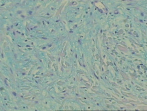 Papular mucinosis pathology, staining with Alcian blue