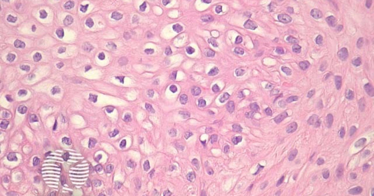 Pilar Sheath Acanthoma Pathology Image