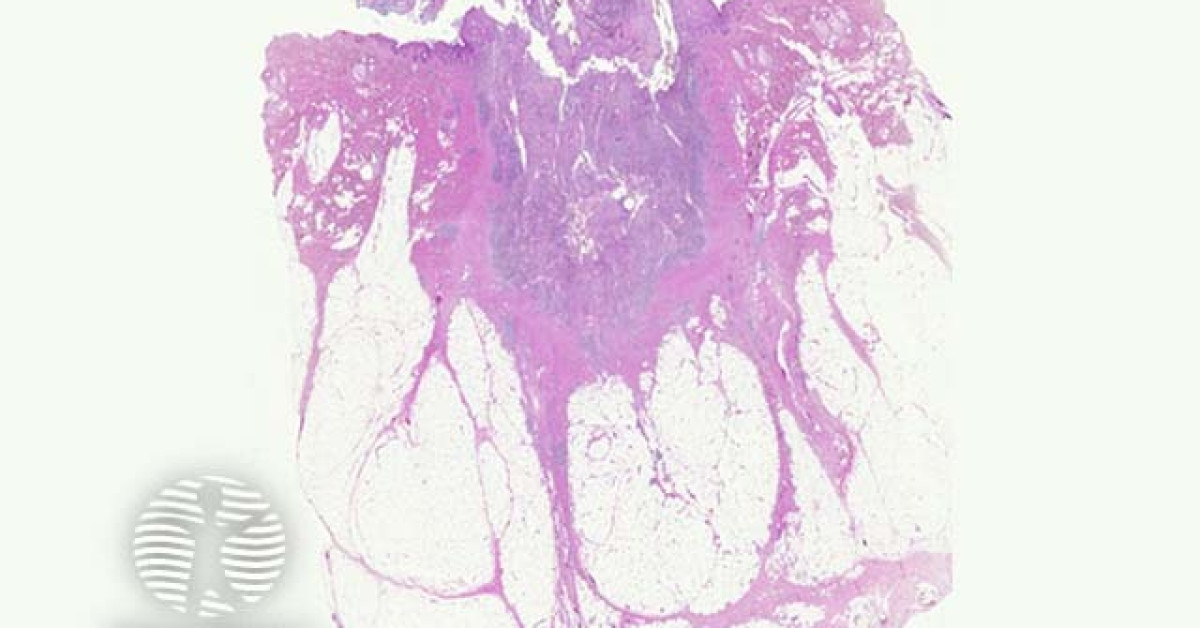 Pilonidal sinus pathology image