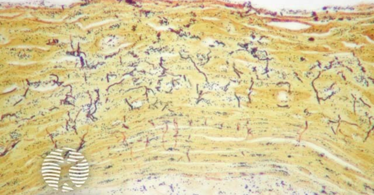 Pitted keratolysis pathology image