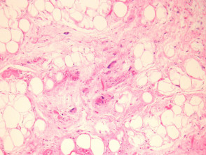 Pleomorphic lipoma pathology