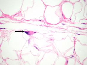 Pleomorphic lipoma pathology