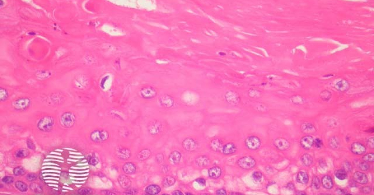 Proliferating trichilemmal cyst pathology image