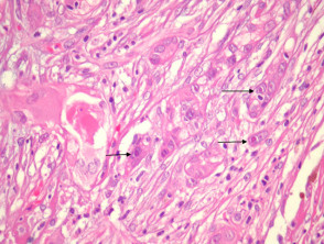 Proliferating trichilemmal cyst pathology