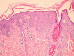 Pityriasis rubra pilaris pathology