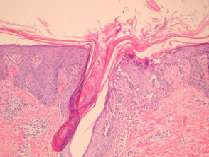 Pityriasis rubra pilaris pathology