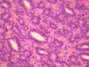 Polymorphous sweat gland carcinoma pathology