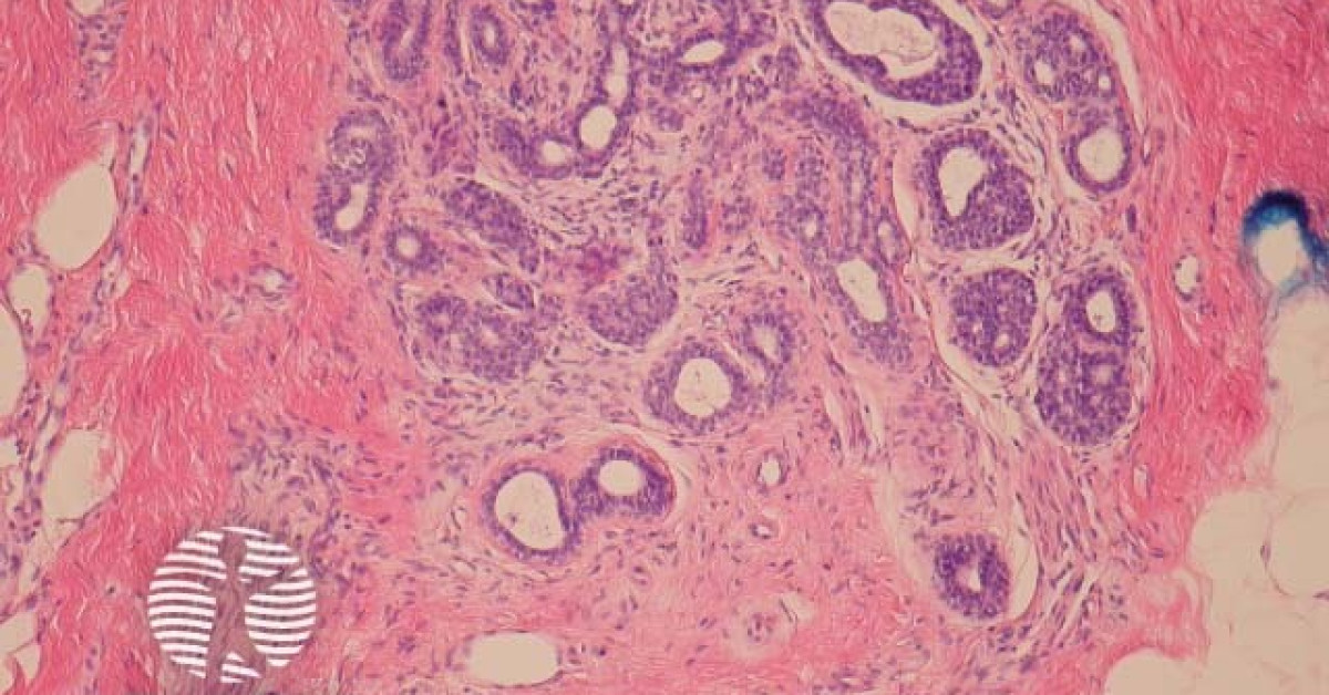 DermNet® - Polymorphous Sweat Gland Carcinoma Pathology Image