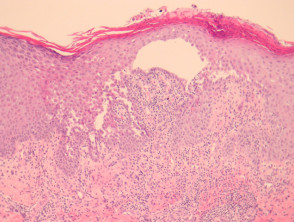 pemphigus erythematosus histology