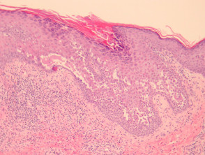 mucous membrane pemphigoid histology