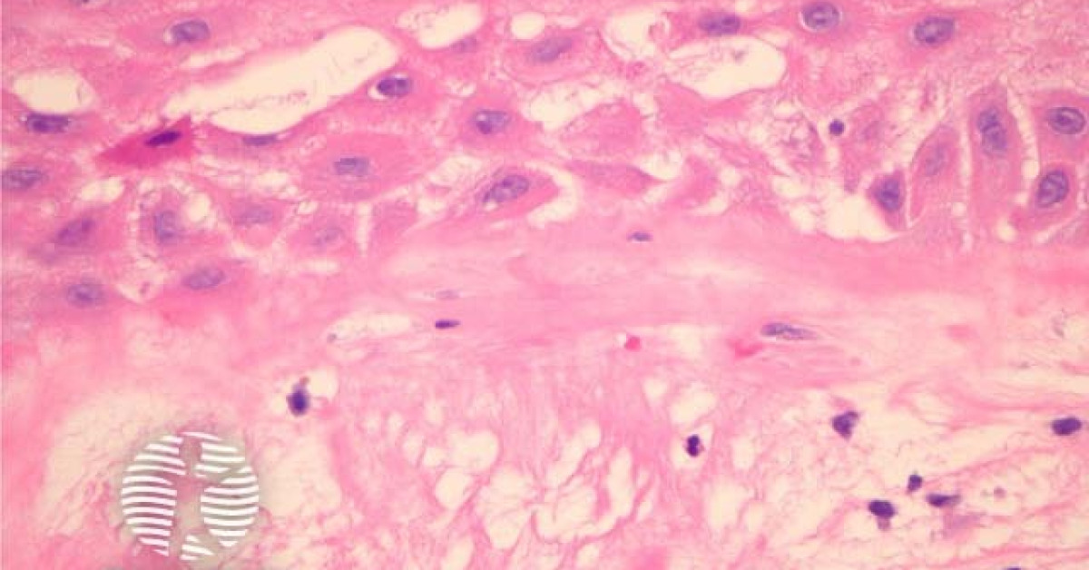 Radiation dermatitis pathology image