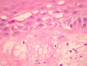 Radiation dermatitis pathology