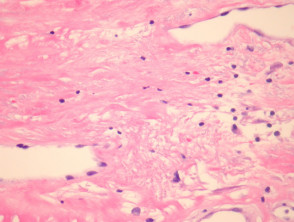 Radiation dermatitis pathology