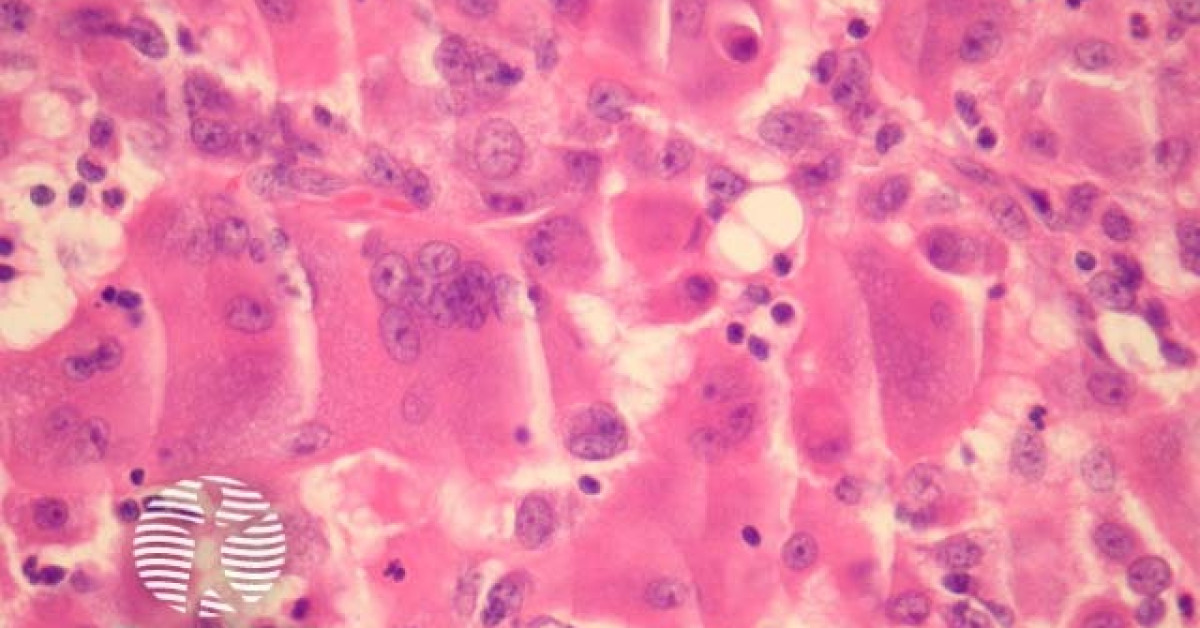 Multicentric Reticulohistiocytosis Pathology