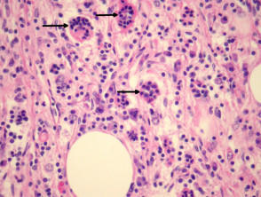 Rosai-Dorfman disease pathology
