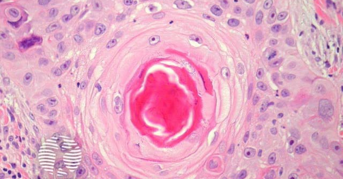 Moderately Differentiated Squamous Cell Carcinoma Pathology Image