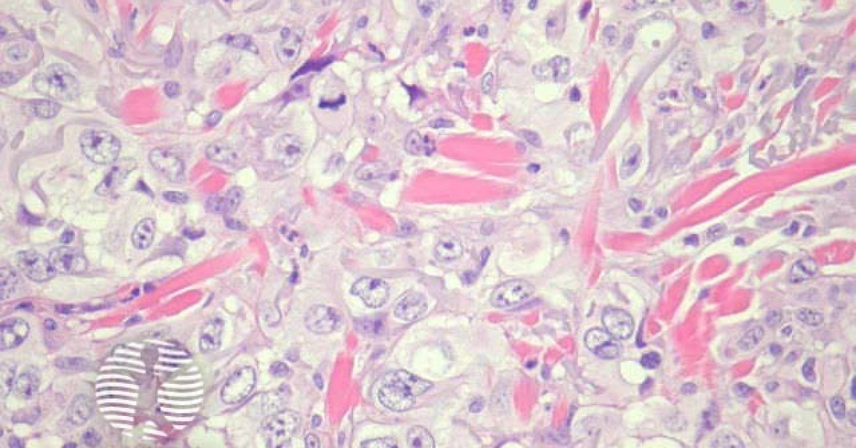 Dermnet® Poorly Differentiated Squamous Cell Carcinoma Pathology Image