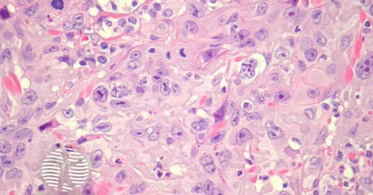 Dermnet® Poorly Differentiated Squamous Cell Carcinoma Pathology Image