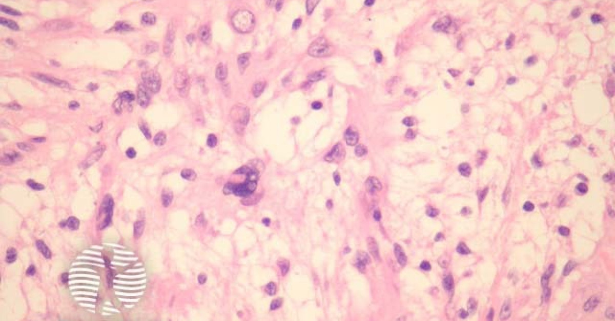 Schwannoma pathology image