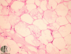 Sclerema neonatorum pathology